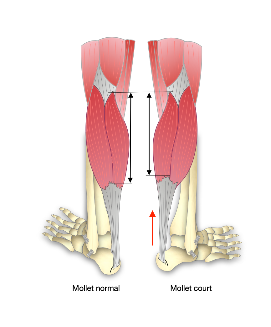 Rétraction des muscles du mollet - Dr Bovier-Lapierre