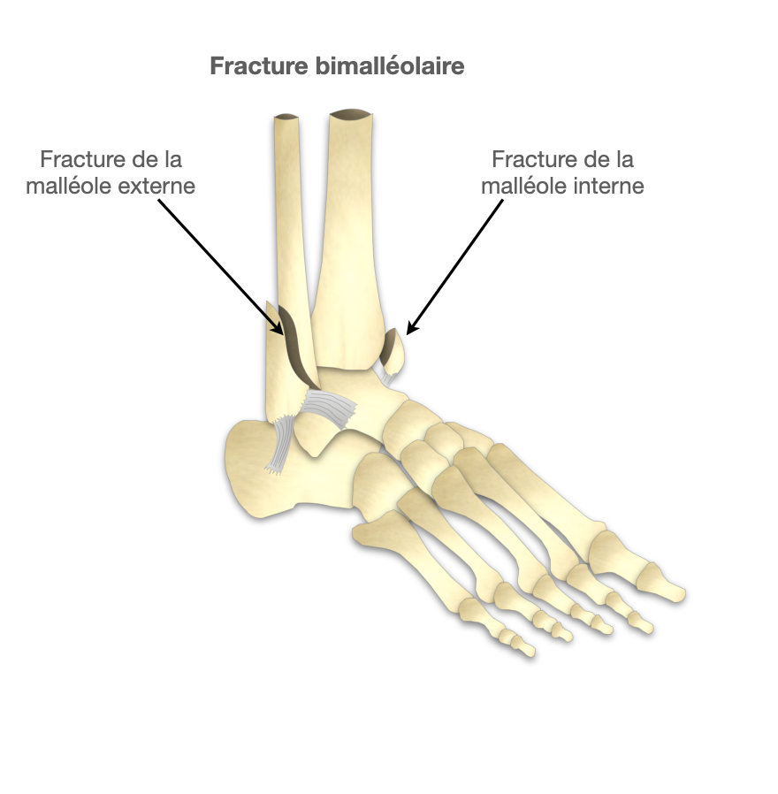 Fracture bi malléolaire - Dr Bovier-Lapierre