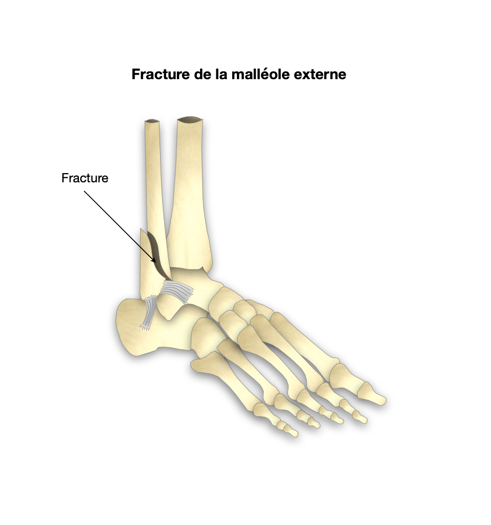 Fracture de la malléole externe - Dr Bovier-Lapierre